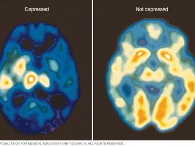 c7_pet_depression-8col c7_pet_depression-8col